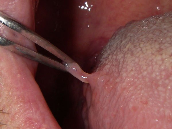 papilloma bordo linguale